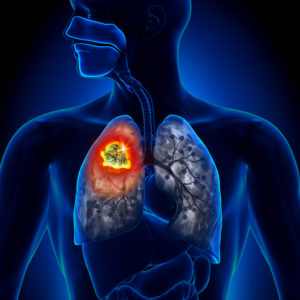 Life Insurance Chronic Obstructive Pulmonary Disease: Underwriting COPD